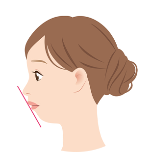 アデノイド顔貌