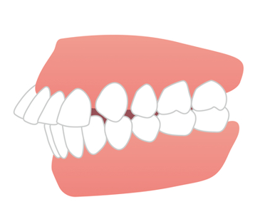 上顎前突 (出っ歯)　種類