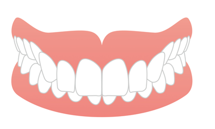 過蓋咬合(かがいこうごう)