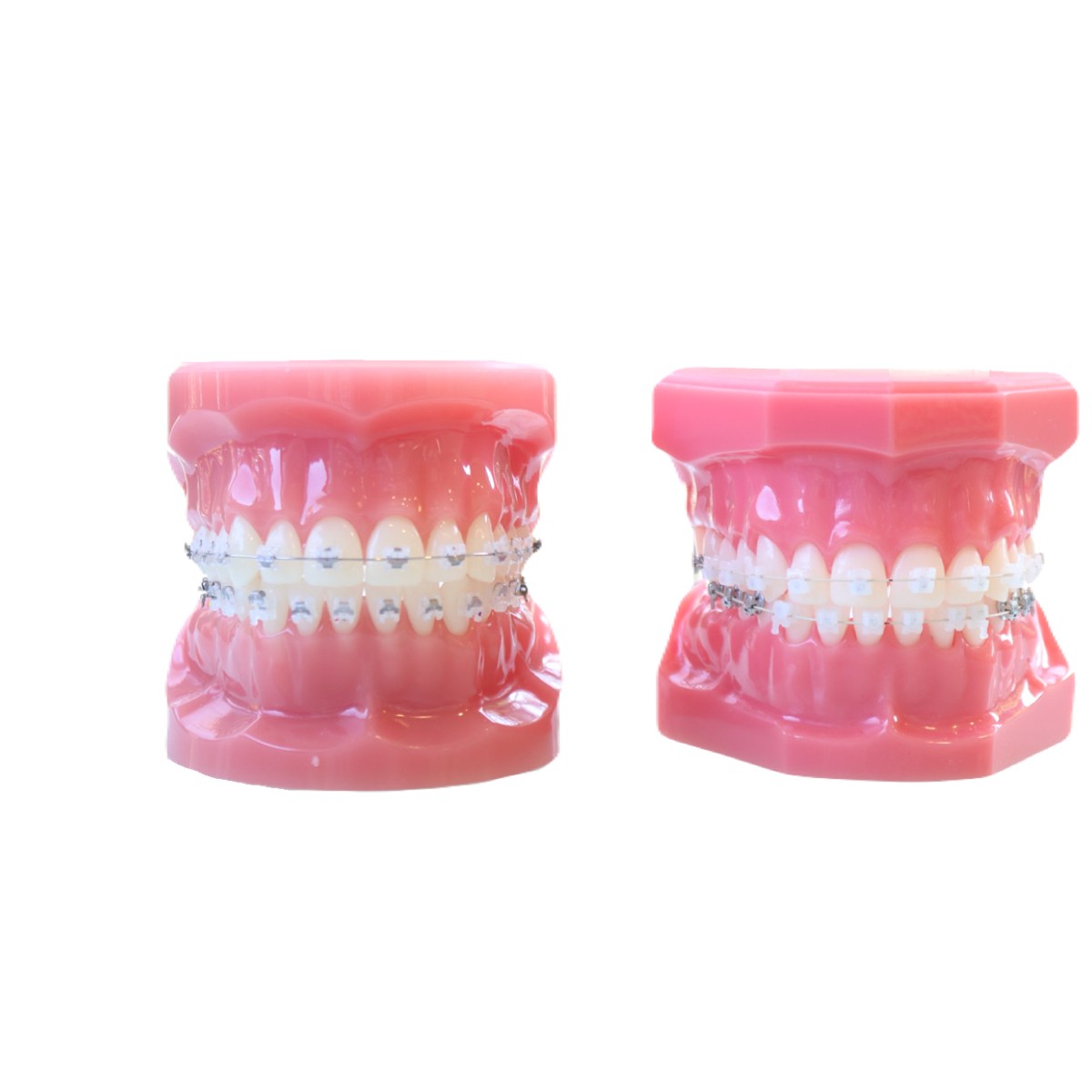 ワイヤー矯正（表側・舌側）