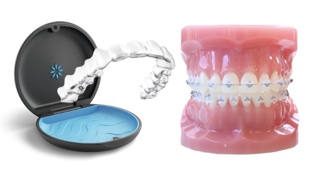 マウスピース型カスタムメイド矯正装置＋ワイヤー矯正の併用（ハイブリッド矯正）