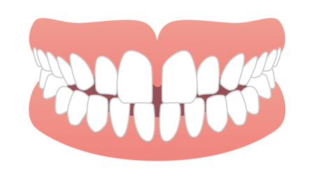 空隙歯列 (すきっ歯)