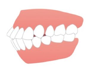 口ゴボ矯正（上下顎前突）