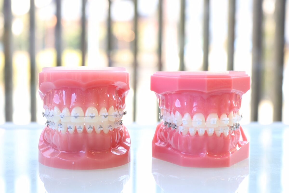 ワイヤー矯正について